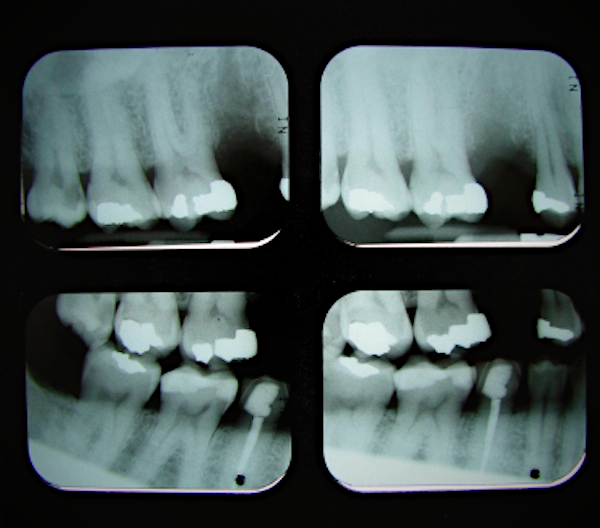 Filling fell out of tooth? What now? How much cost to fix? - Bauer